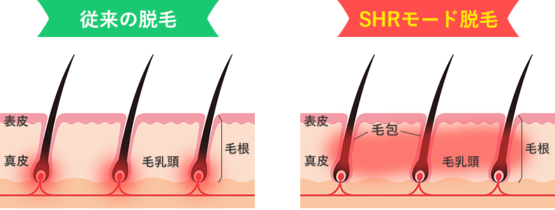 SHRモード脱毛